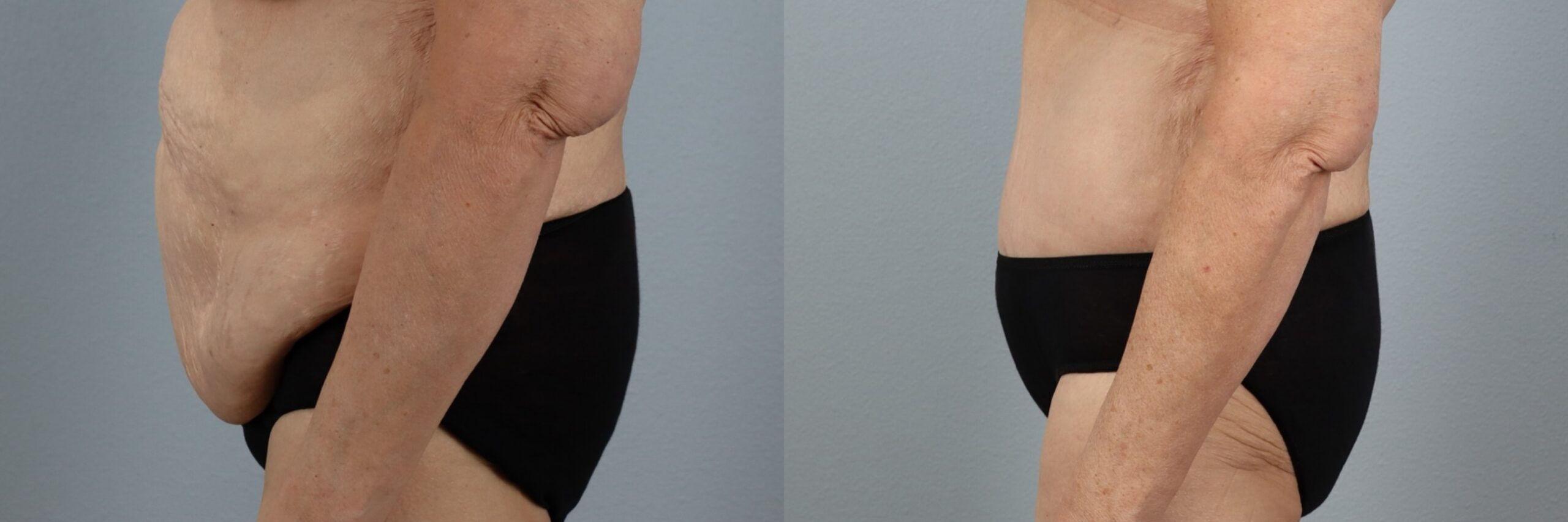 Before and after – Tummy Tuck – Female patient, age 60+ – Image 51