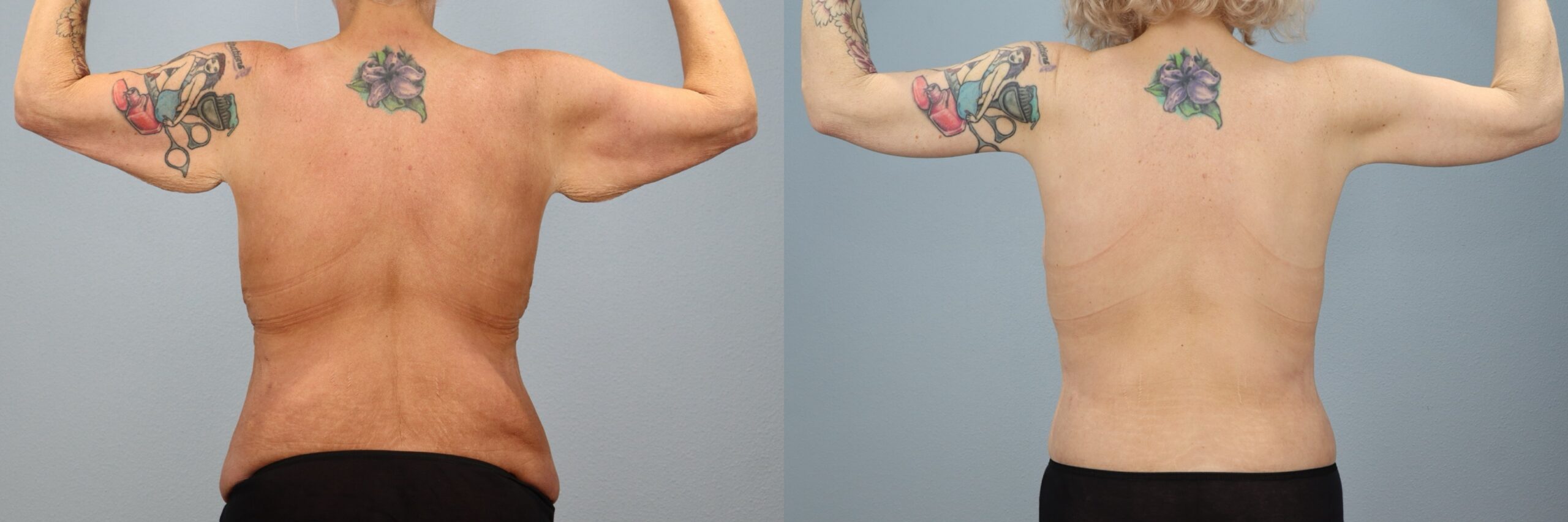 Before and after – Body Contouring – Female patient, age 50-59 – Image 2