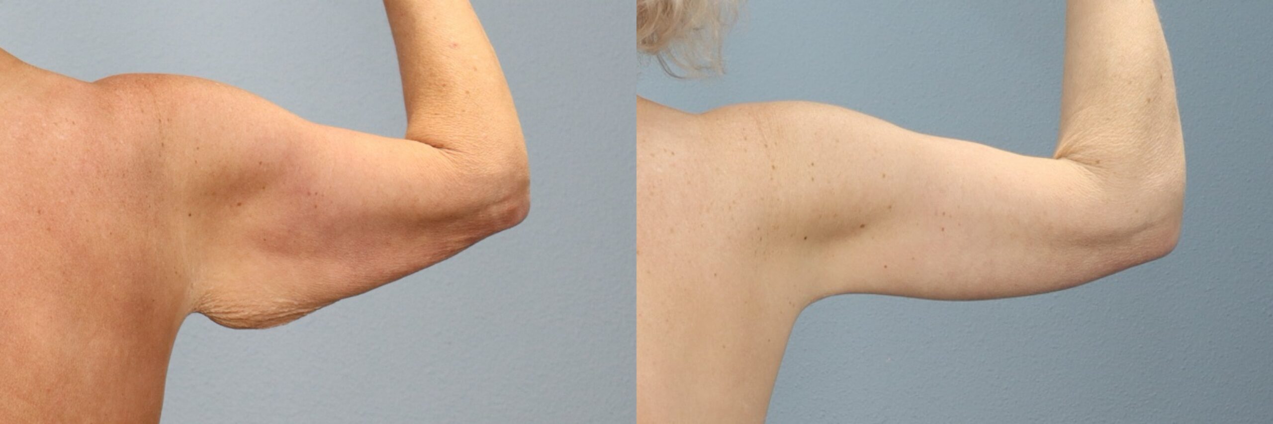 Before and after – Body Contouring – Female patient, age 50-59 – Image 3