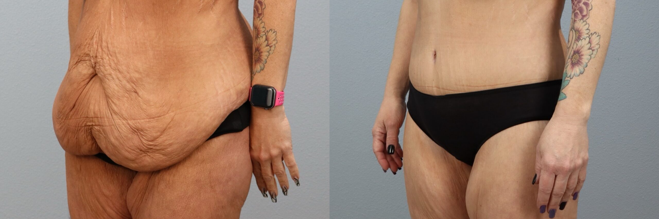 Before and after – Body Lift – Female patient, age 50-59 – Image 44