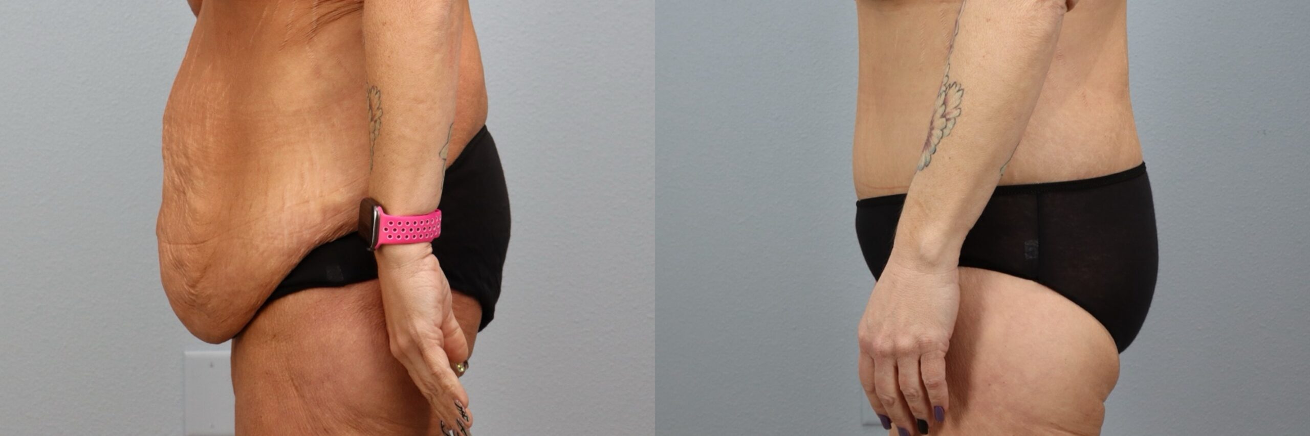 Before and after – Body Lift – Female patient, age 50-59 – Image 45