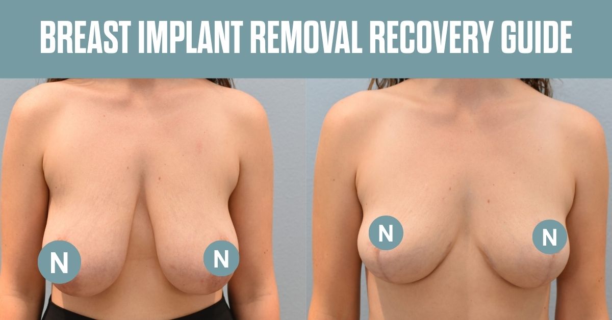 Breast Implant Removal Guide Thumbnail