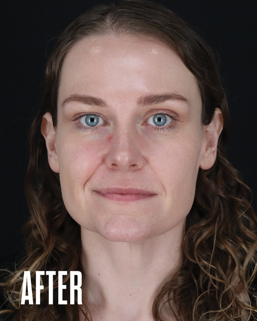 Forehead lines after Botox