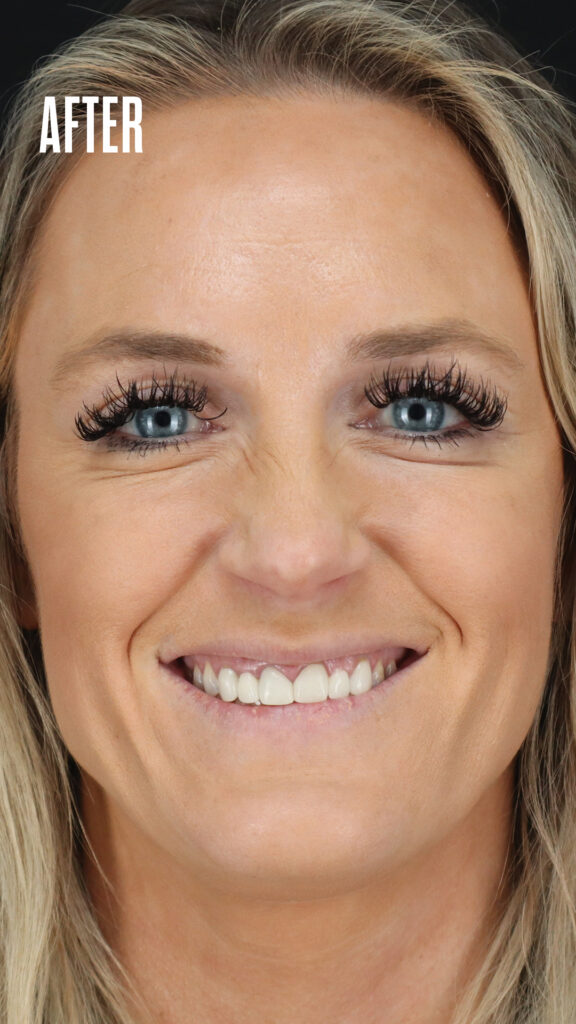 Crows feet after Botox