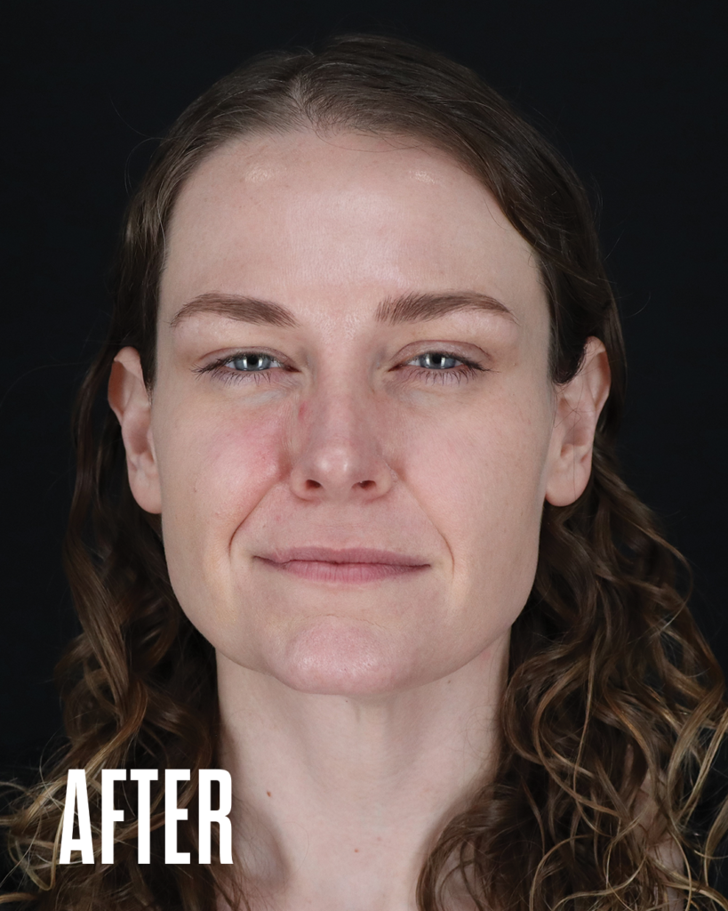 Glabella frown lines after Botox