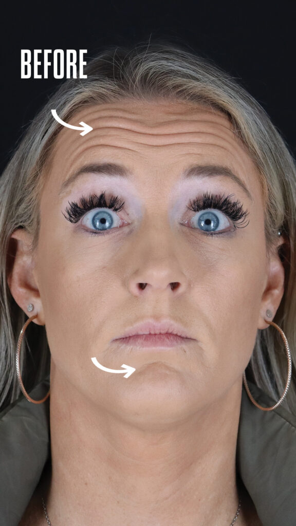 Forehead lines before Botox