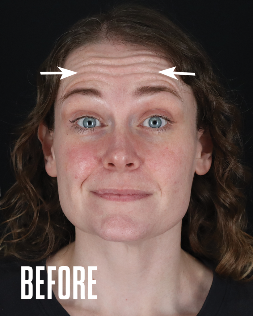 Forehead lines before Botox