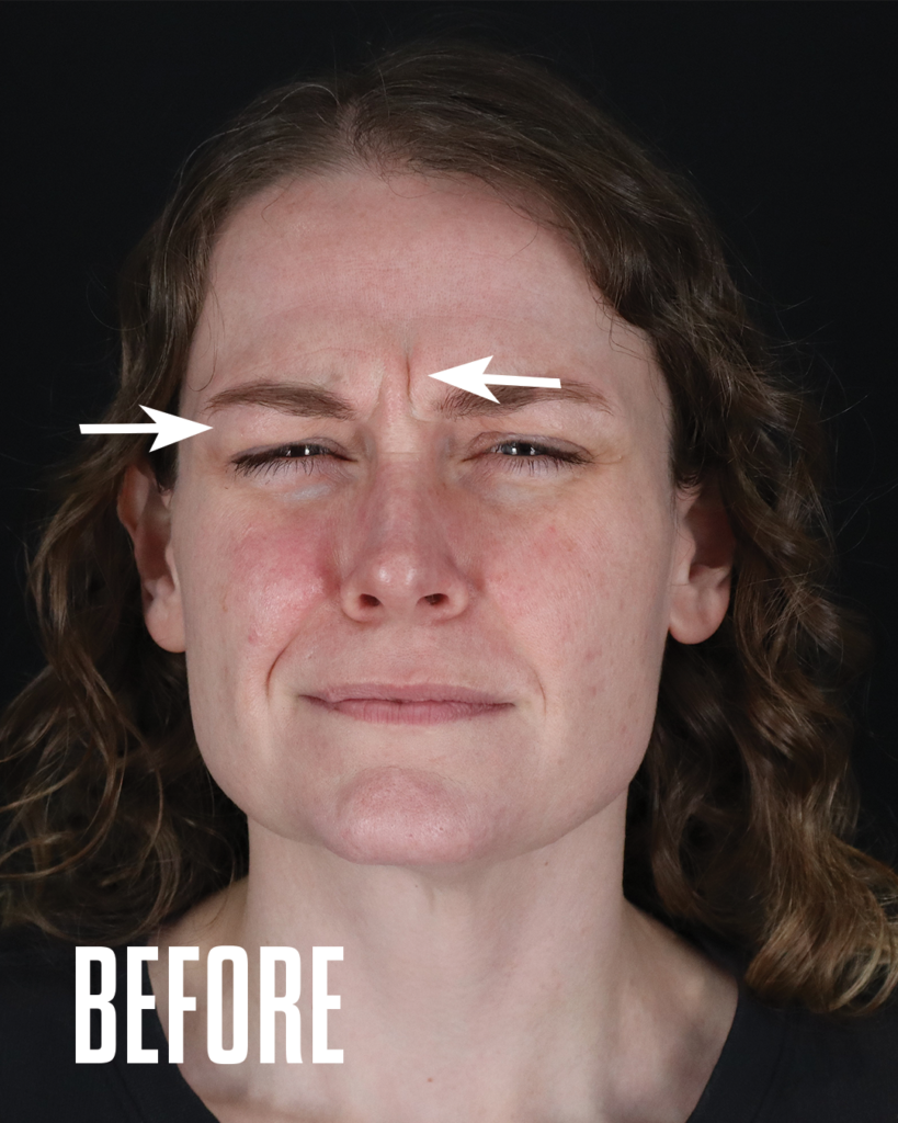 Labella frown lines before Botox