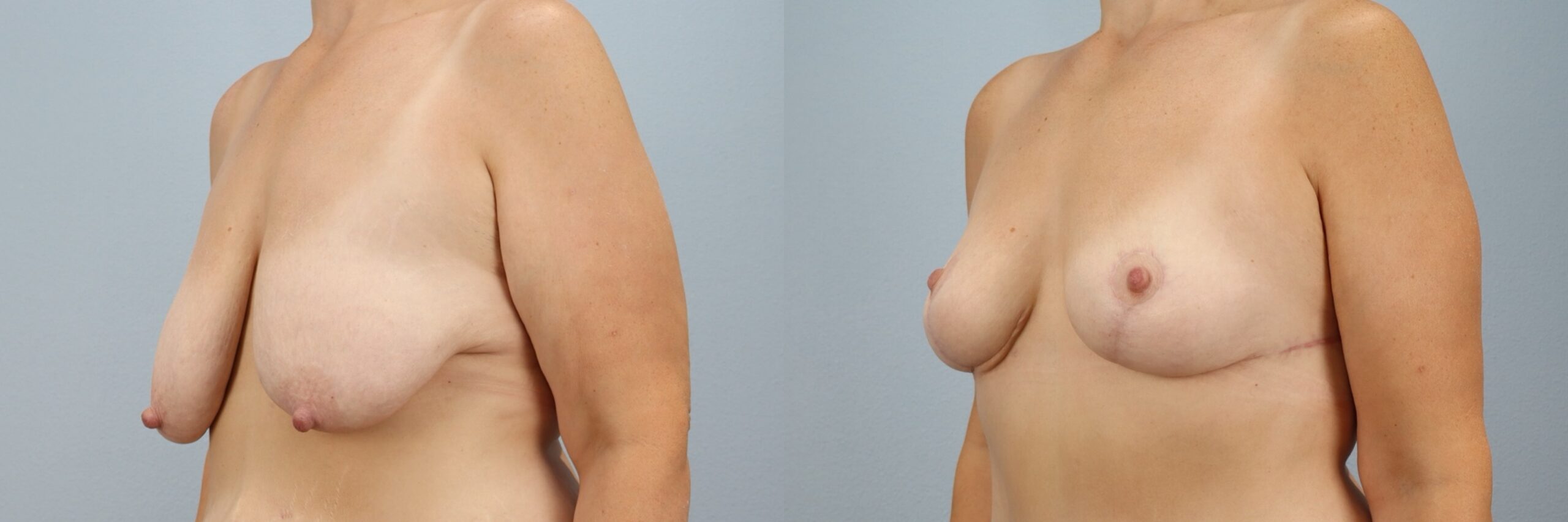 Before and after – Breast Lift – Female patient, age 40-49 – Image 8