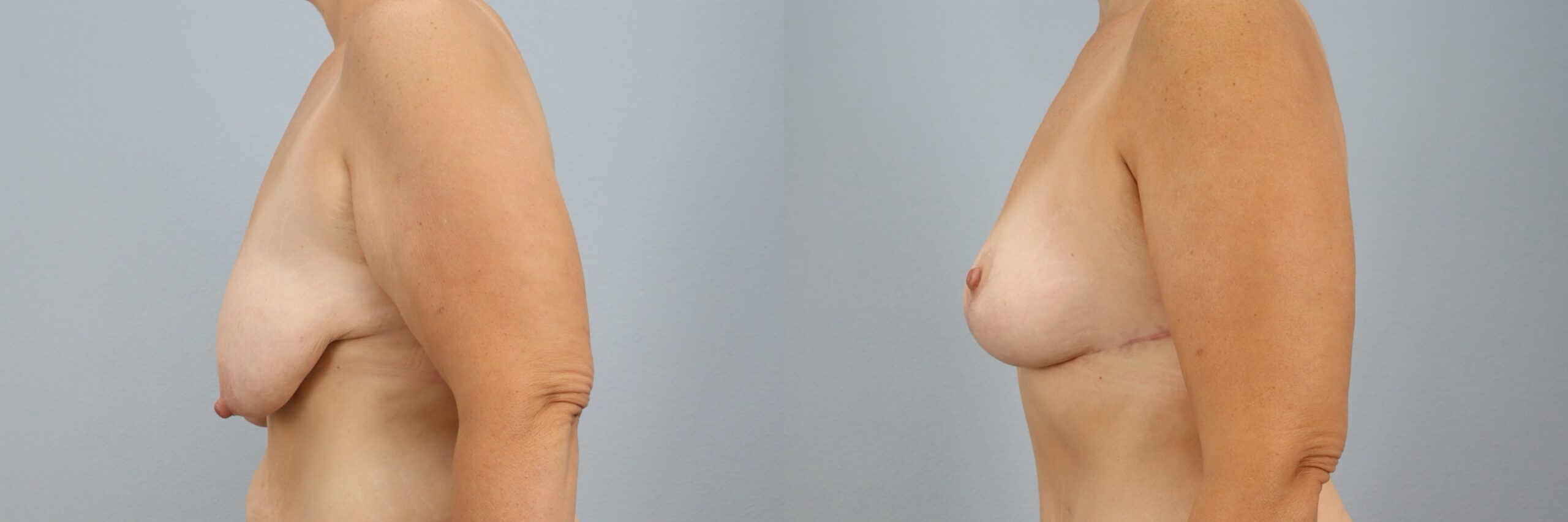 Before and after – Breast Lift – Female patient, age 40-49 – Image 9