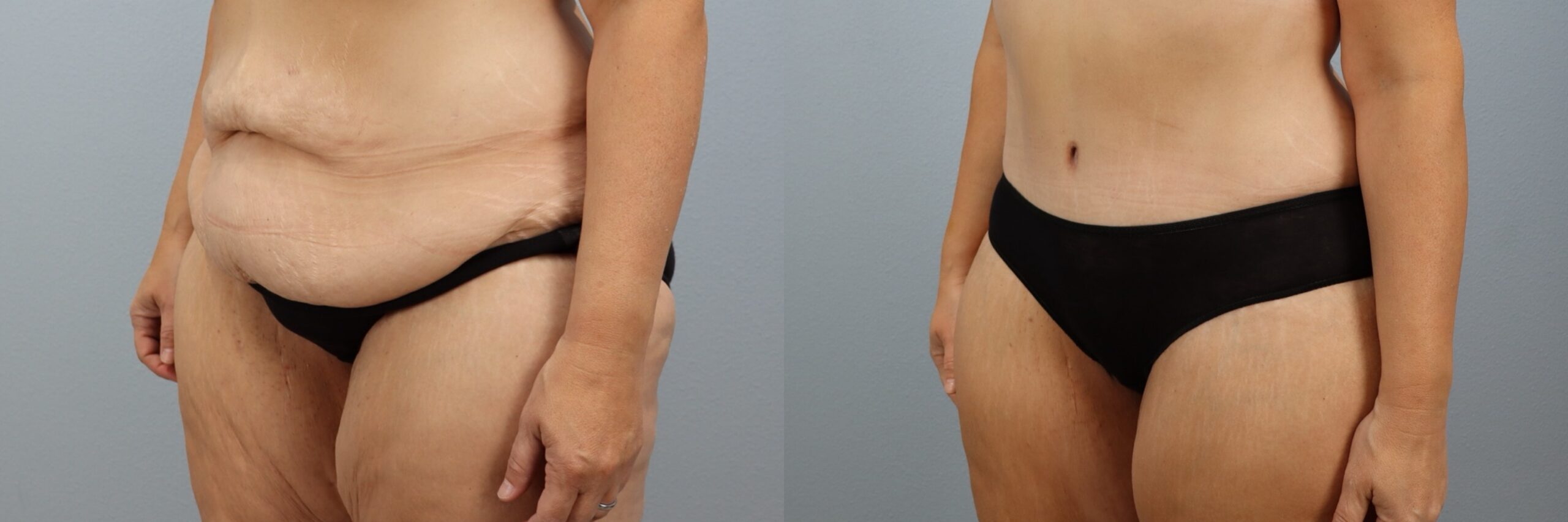 Before and after – Body Contouring – Female patient, age 40-49 – Image 23
