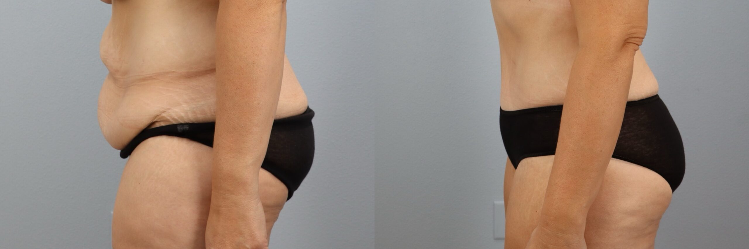 Before and after – Body Contouring – Female patient, age 40-49 – Image 24