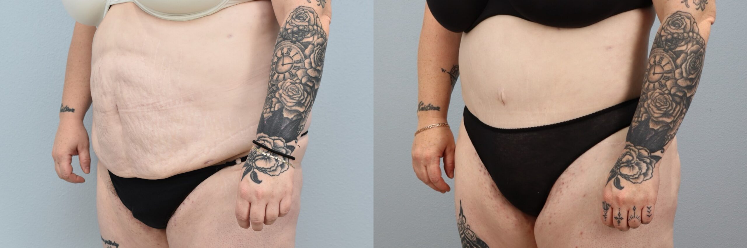 Before and after – Body Contouring – Female patient, age 30-39 – Image 17