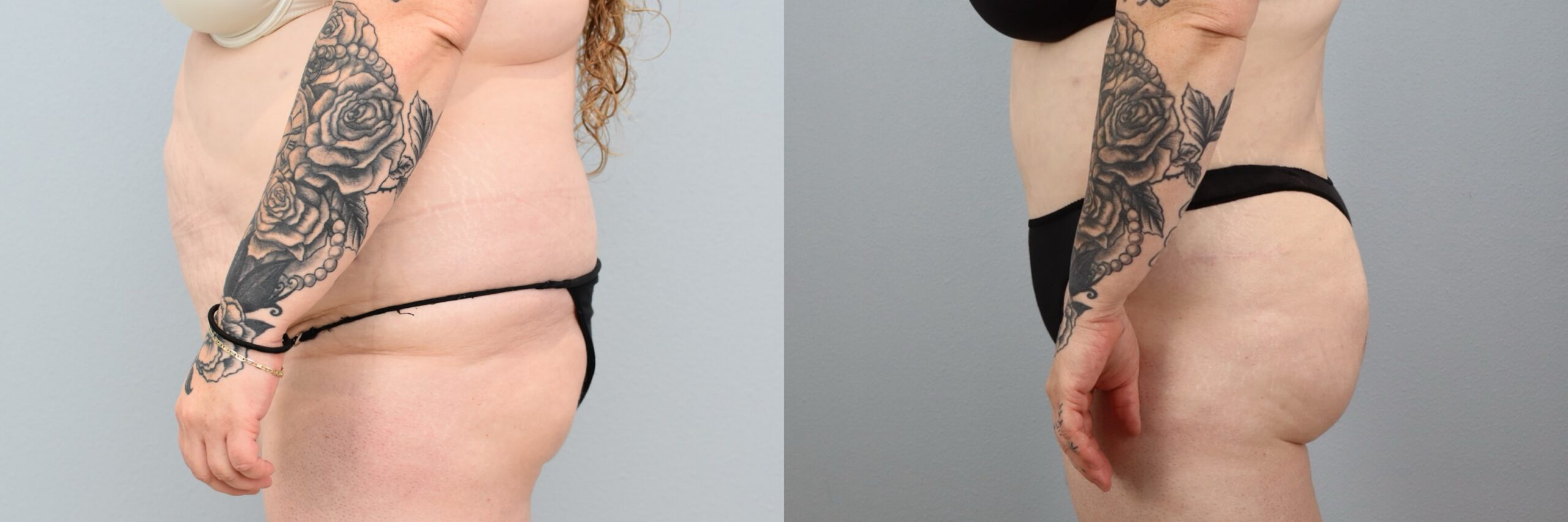 Before and after – Body Contouring – Female patient, age 30-39 – Image 18