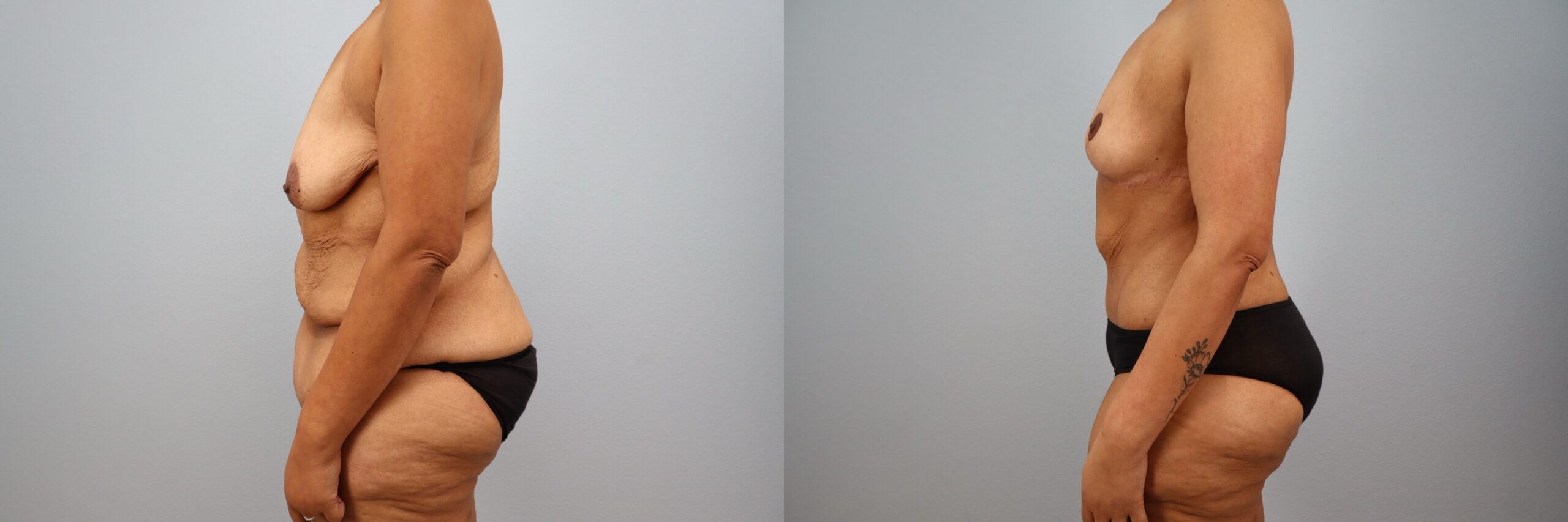 Before and after – Body Contouring – Female patient, age 40-49 – Image 33