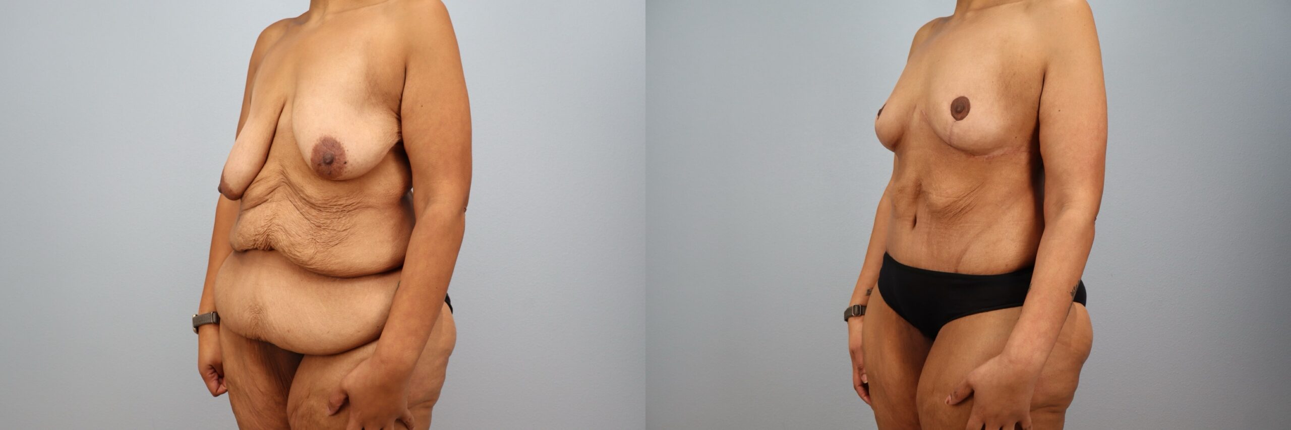 Before and after – Body Contouring – Female patient, age 40-49 – Image 32