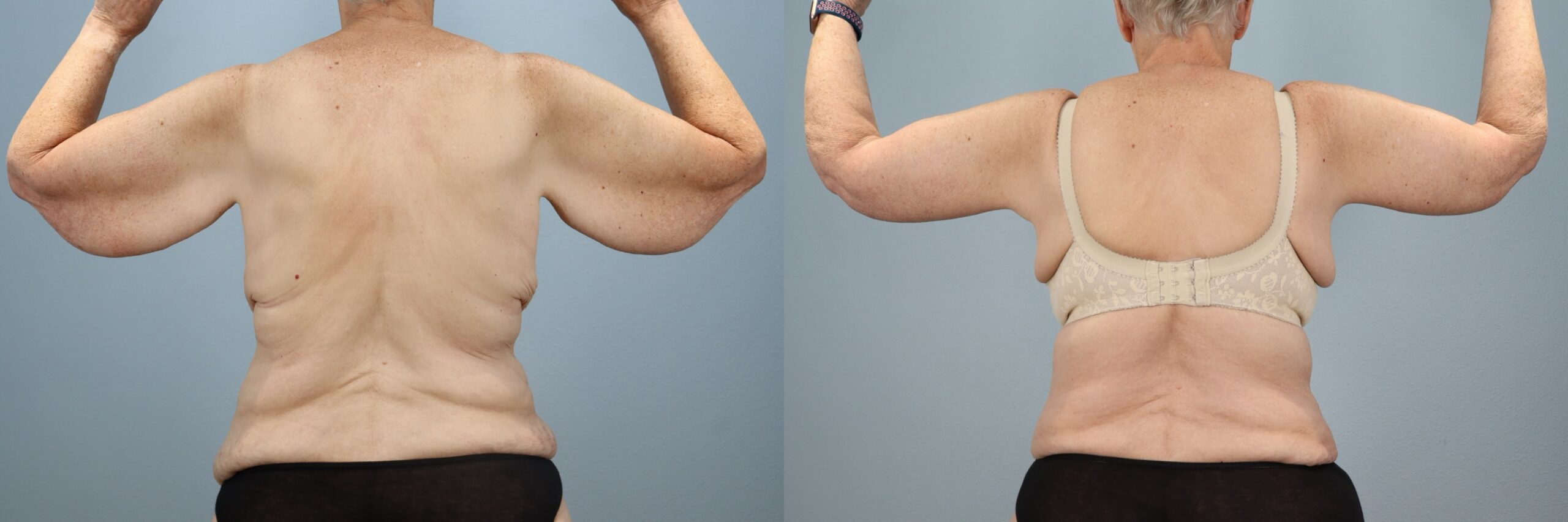 Before and after – Arm Lift – Female patient, age 60+ – Image 16