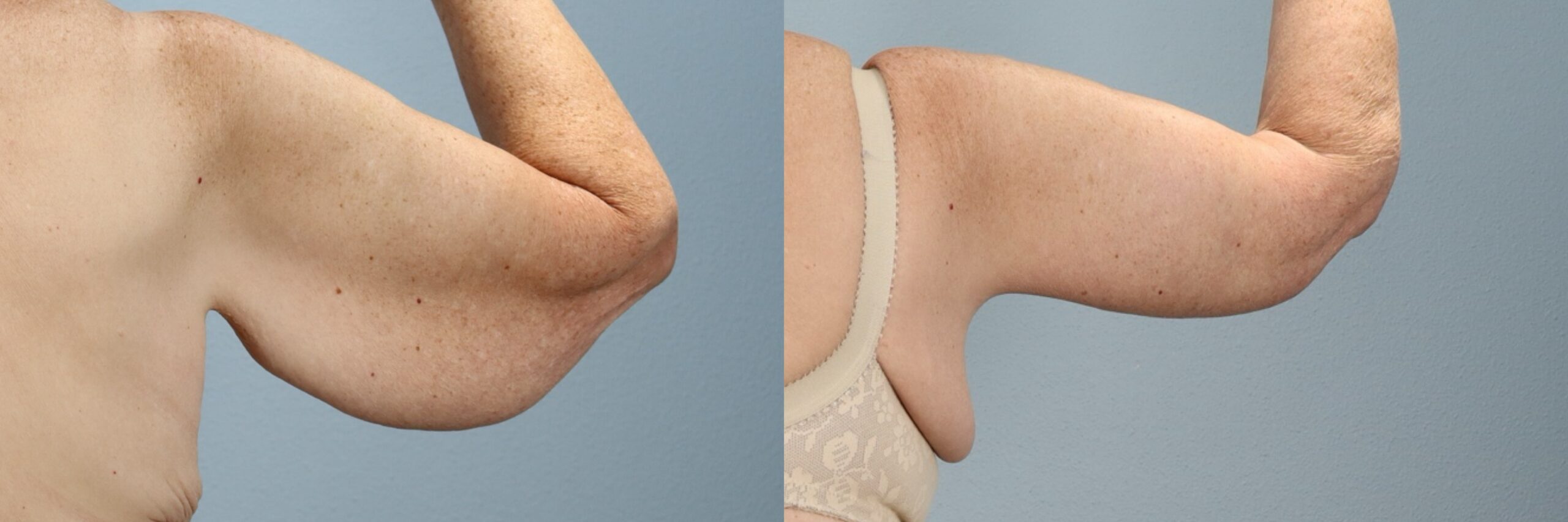 Before and after – Arm Lift – Female patient, age 60+ – Image 17