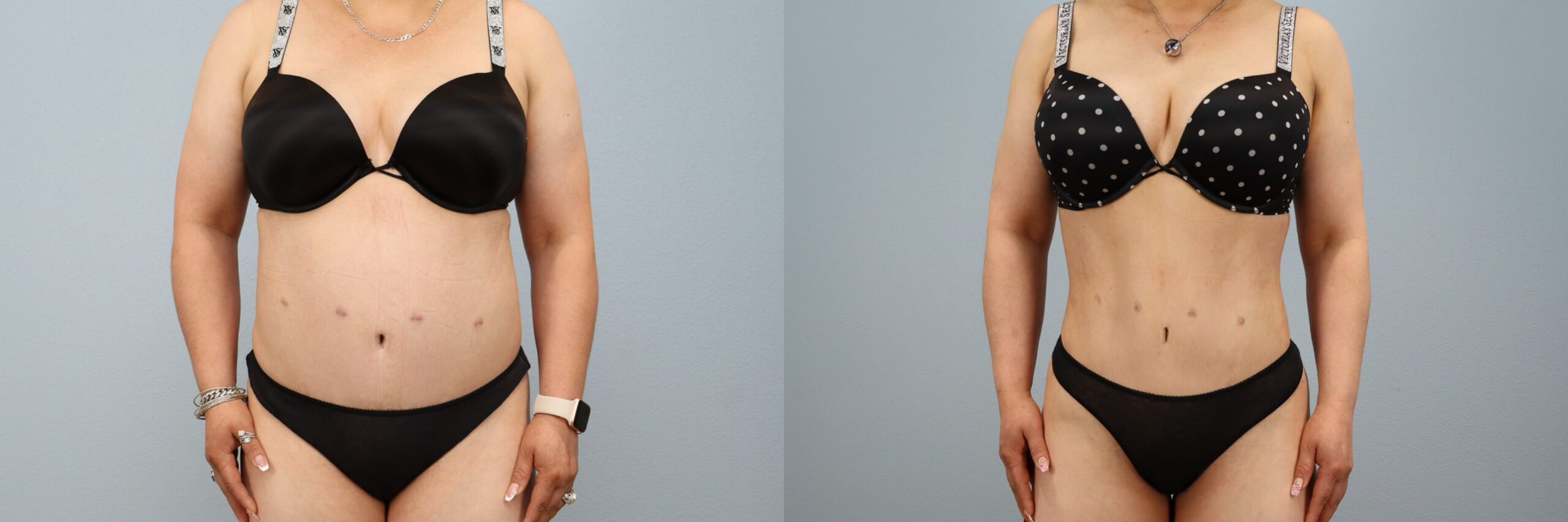 Before and after – Liposuction – Female patient, age 40-49 – Image 1