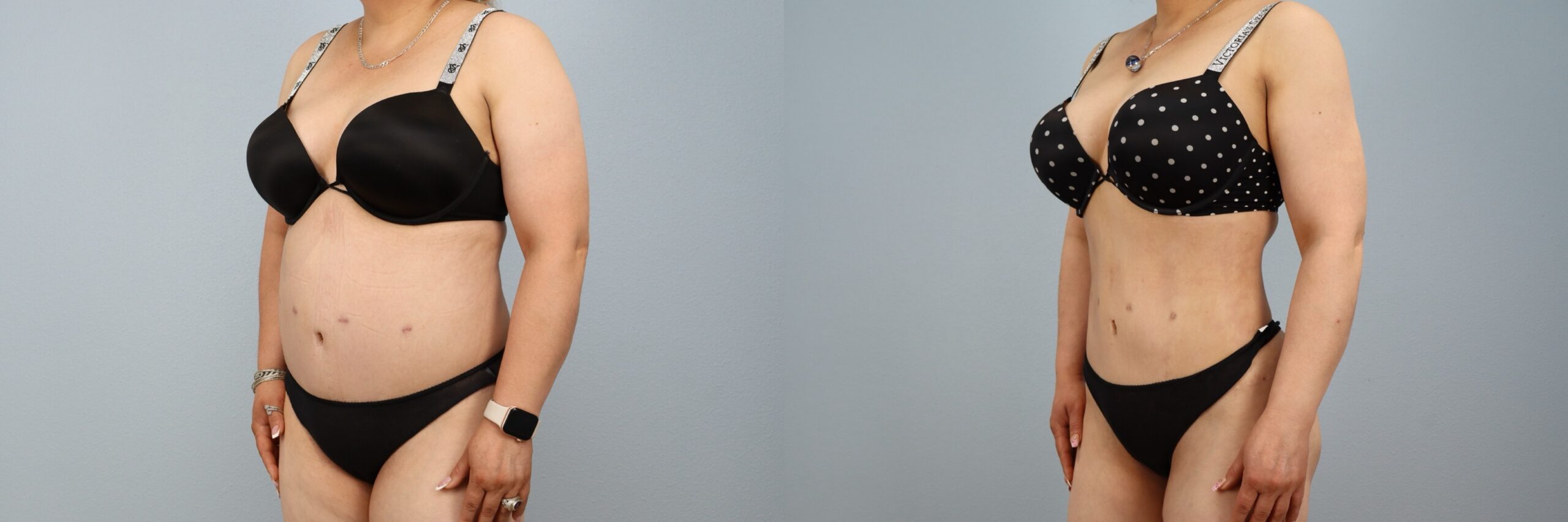 Before and after – Liposuction – Female patient, age 40-49 – Image 2