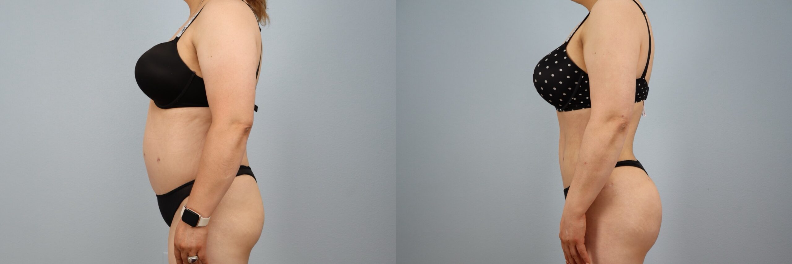 Before and after – Liposuction – Female patient, age 40-49 – Image 3