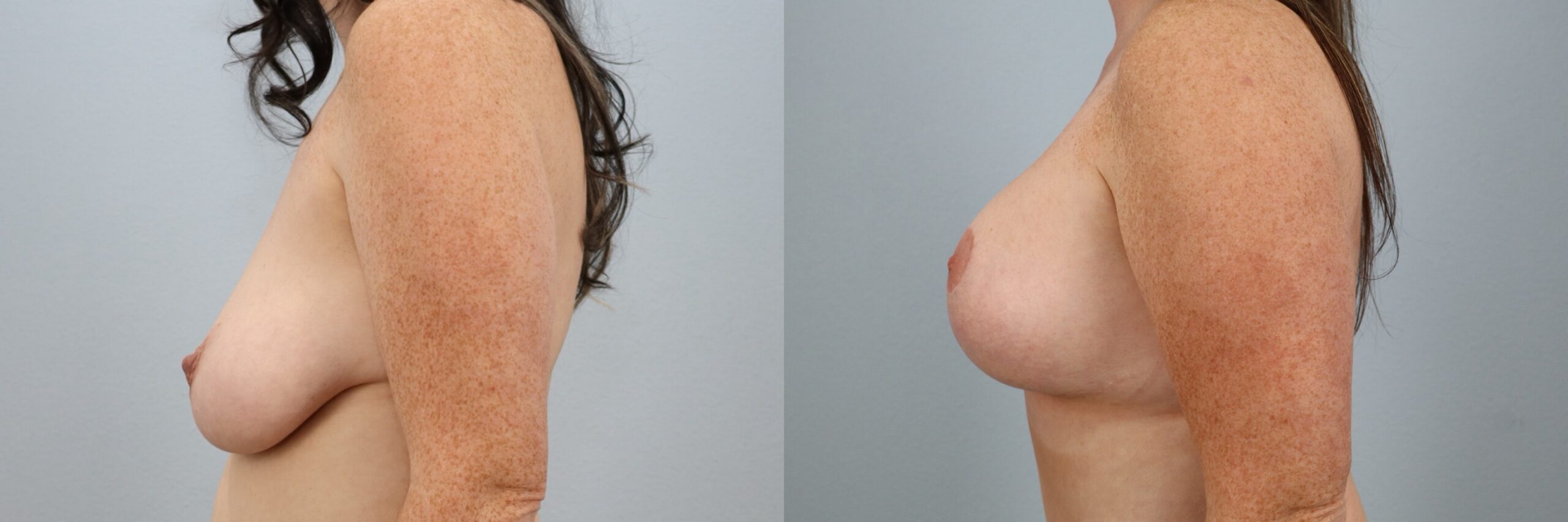 Before and after – Breast Lift With Implants – Female patient, age 30-39 – Image 12