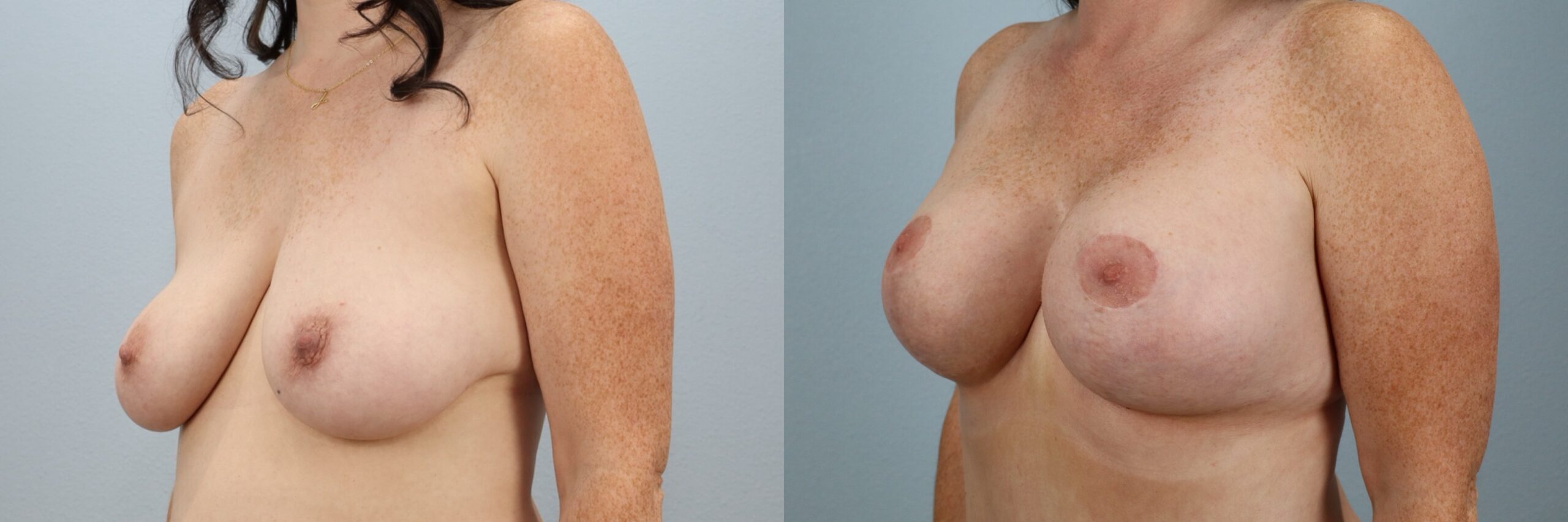 Before and after – Breast Lift With Implants – Female patient, age 30-39 – Image 11