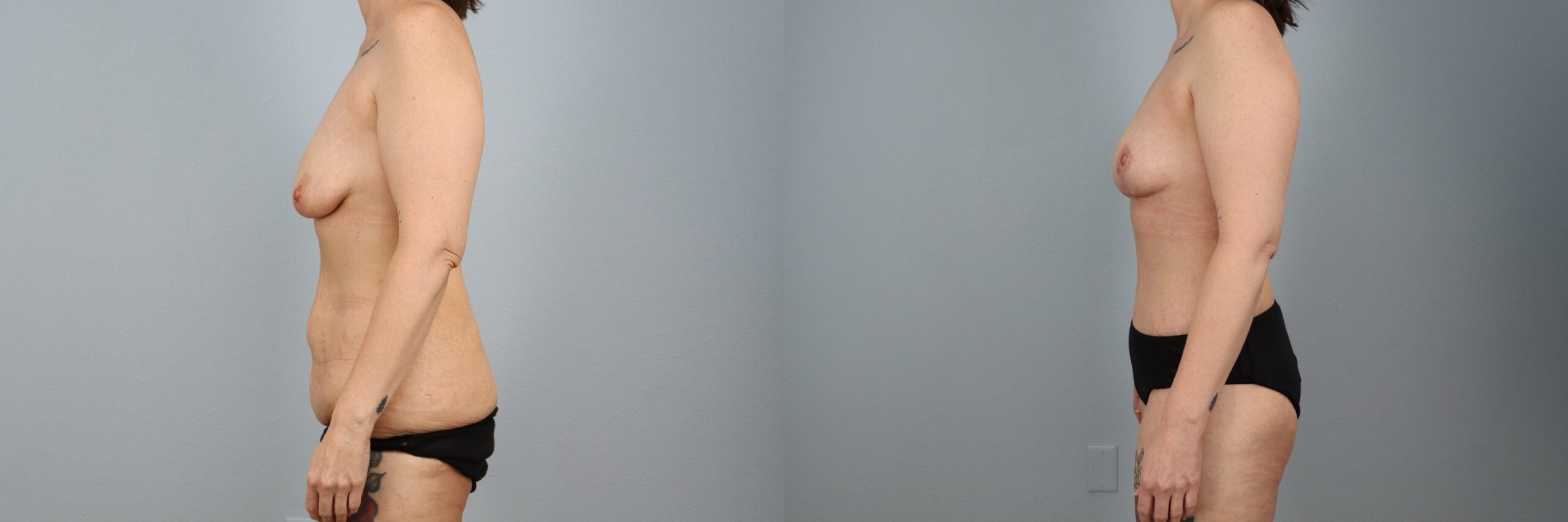 Before and after – Mommy Makeover – Female patient, age 40-49 – Image 18