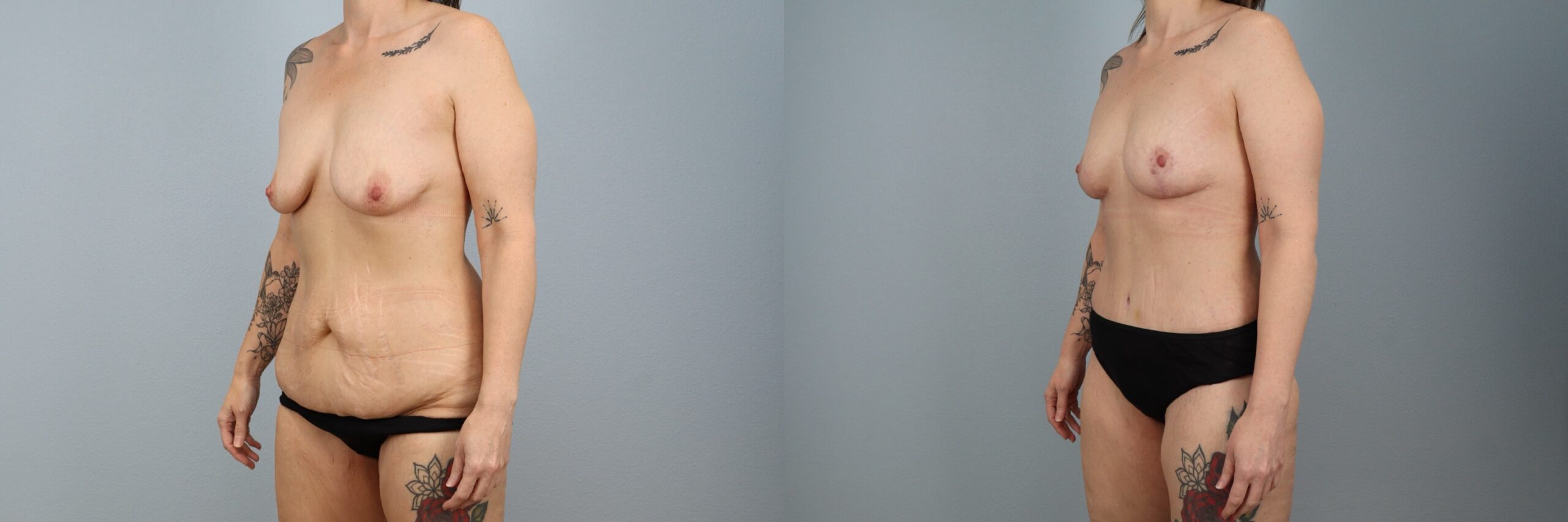 Before and after – Mommy Makeover – Female patient, age 40-49 – Image 17