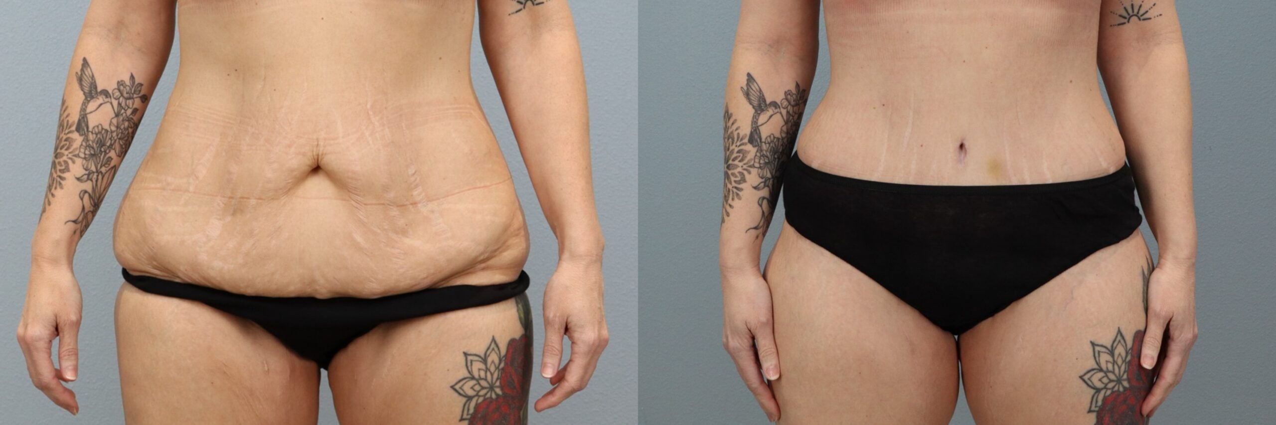 Before and after – Body Contouring – Female patient, age 40-49 – Image 27