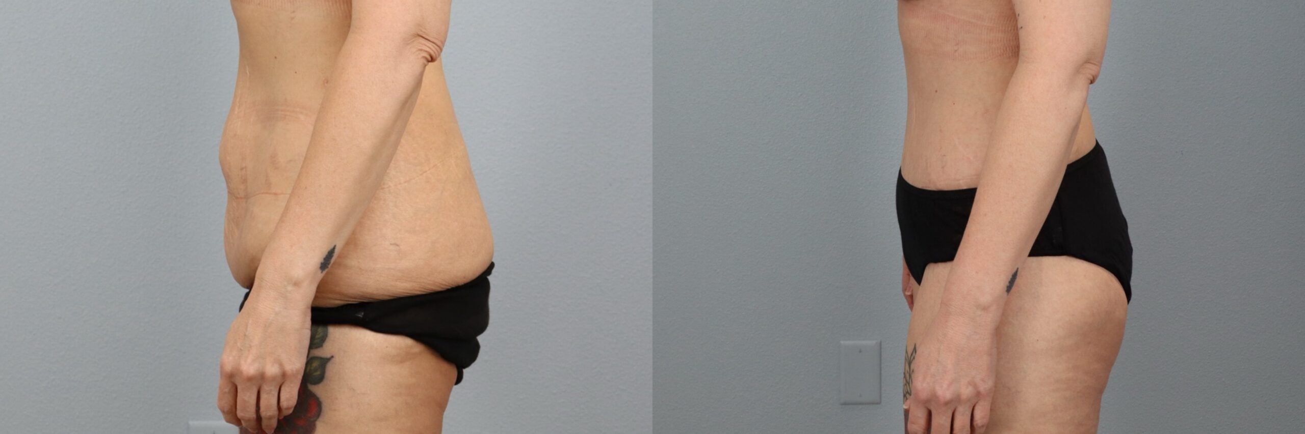 Before and after – Body Contouring – Female patient, age 40-49 – Image 29