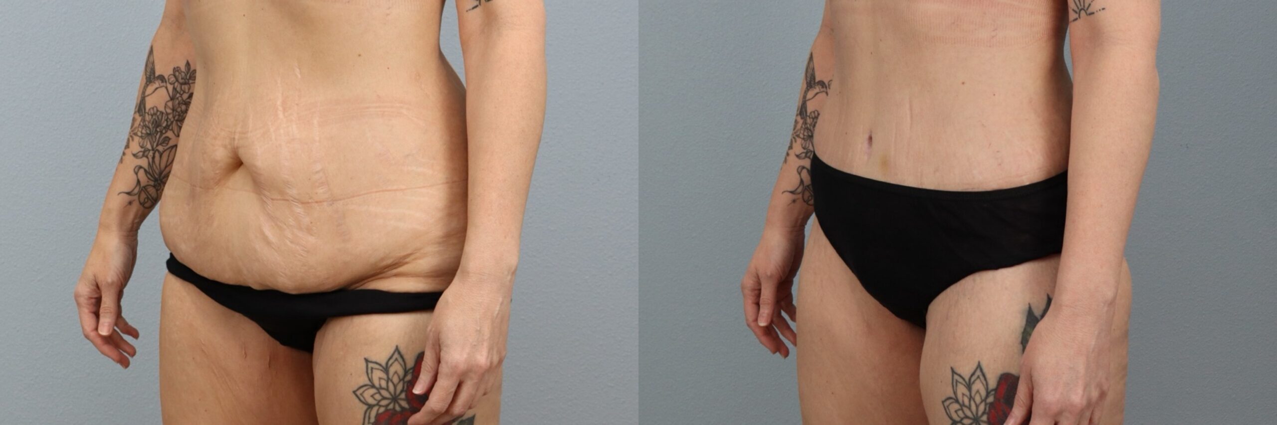 Before and after – Body Contouring – Female patient, age 40-49 – Image 28