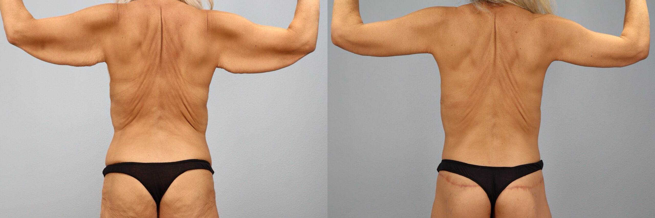 Before and after – Arm Lift – Female patient, age 50-59 – Image 22