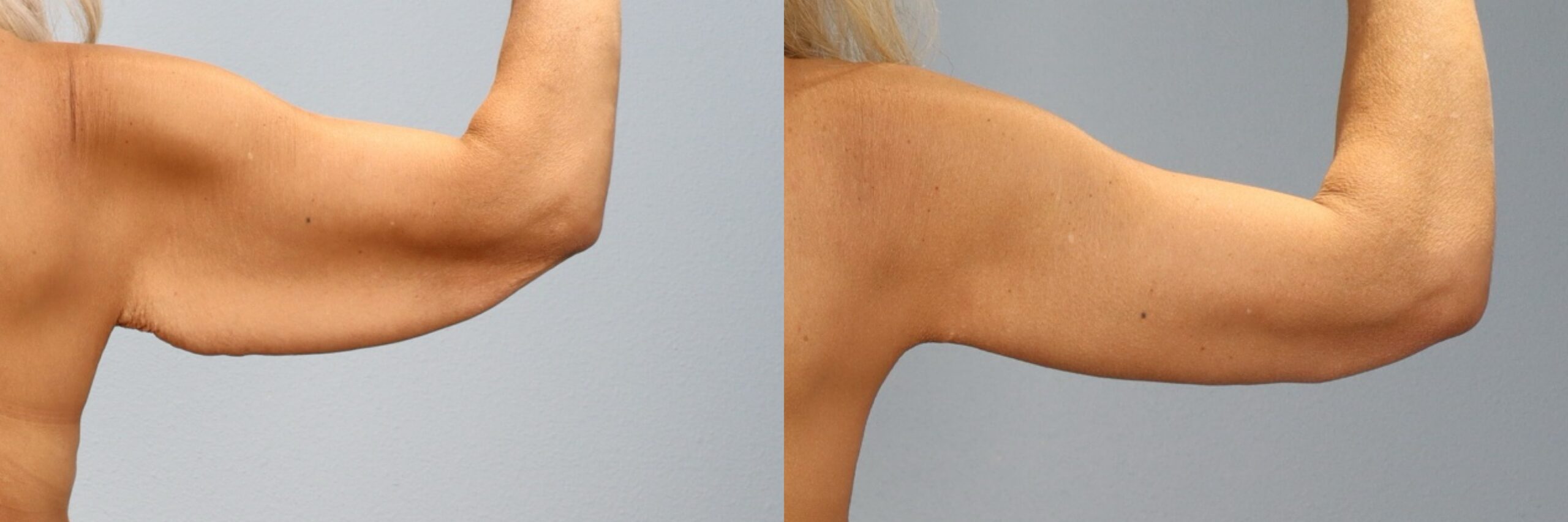 Before and after – Arm Lift – Female patient, age 50-59 – Image 23