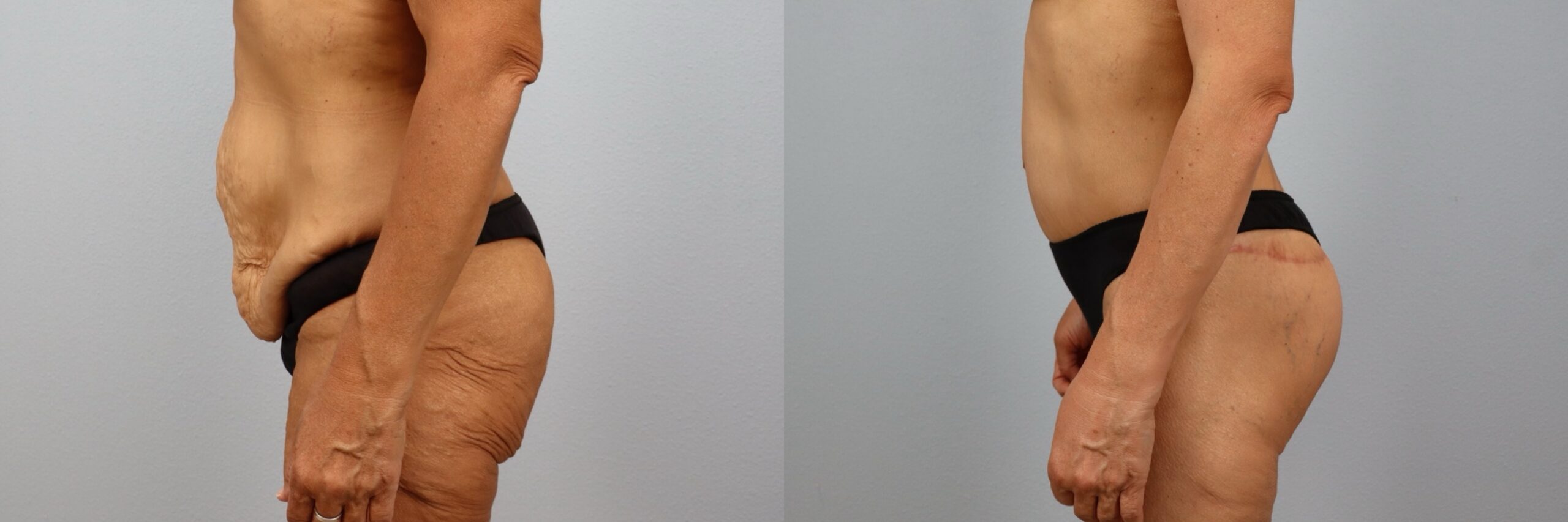 Before and after – Body Lift – Female patient, age 50-59 – Image 45