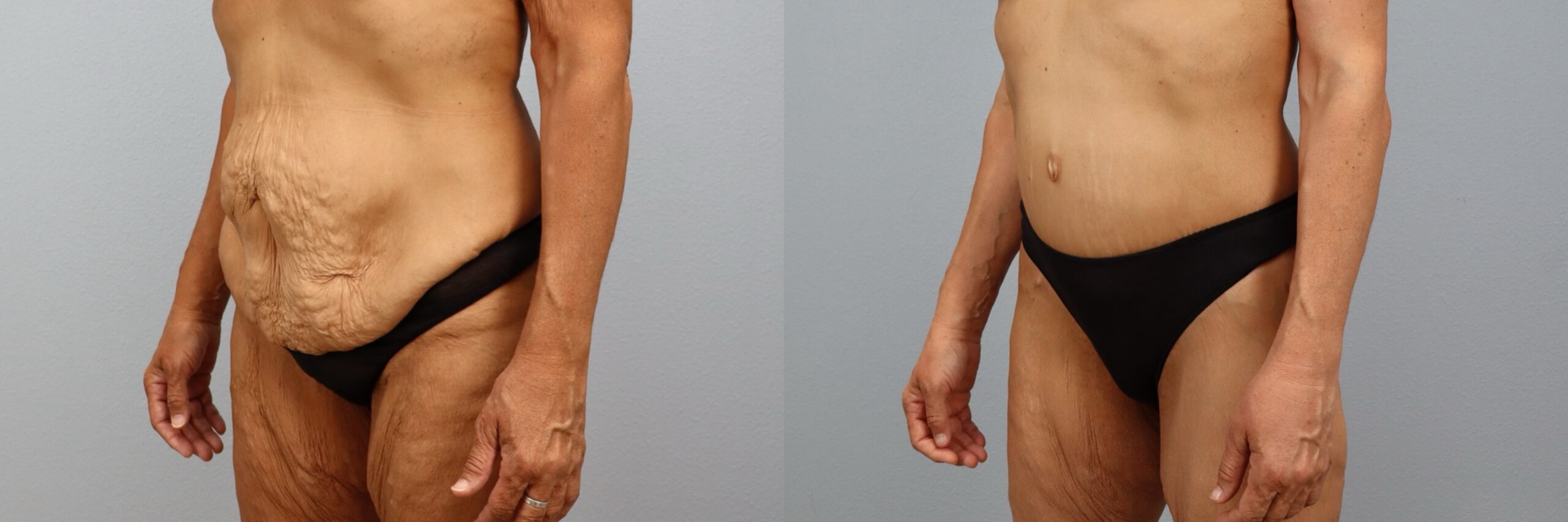 Before and after – Body Lift – Female patient, age 50-59 – Image 44