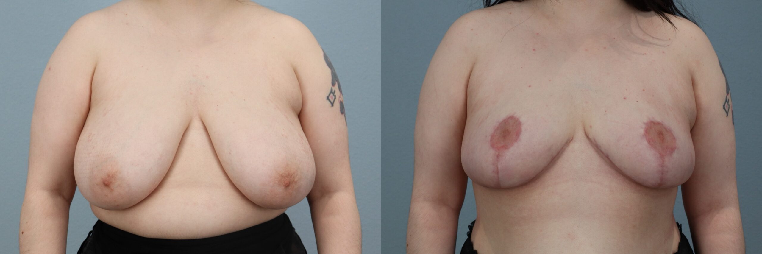 Before and after – Breast Reduction – Female patient, age 20-29 – Image 31