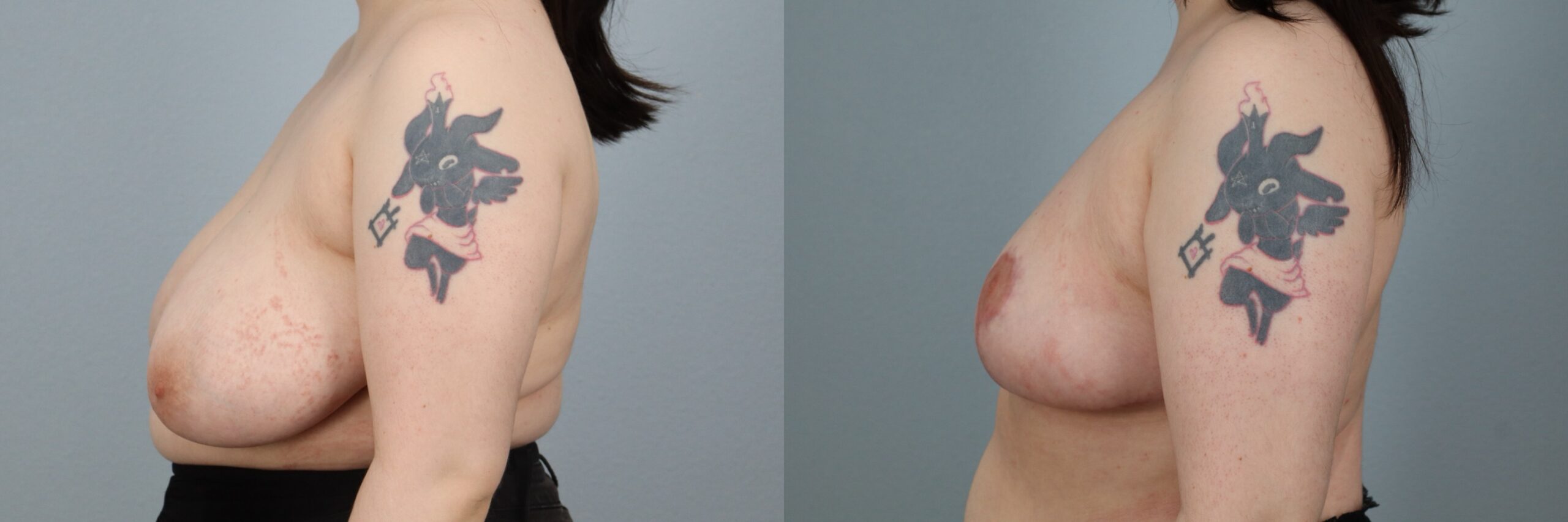 Before and after – Breast Reduction – Female patient, age 20-29 – Image 33