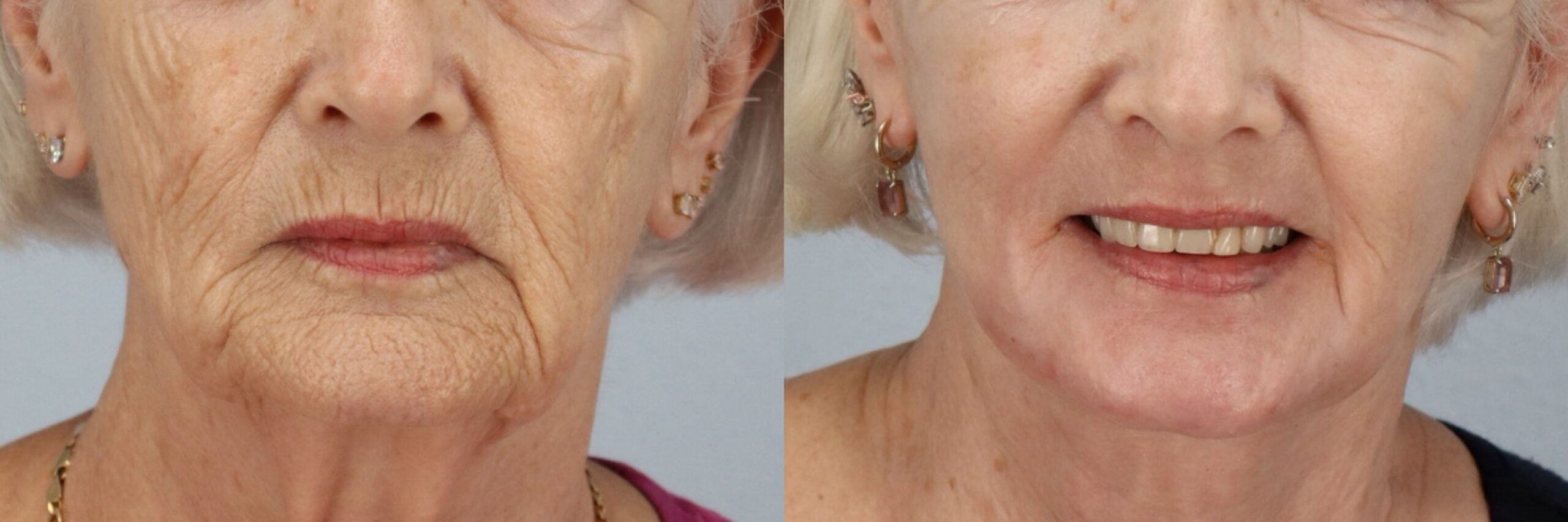 Before and after – Laser Resurfacing – Female patient, age 60+ – Image 7