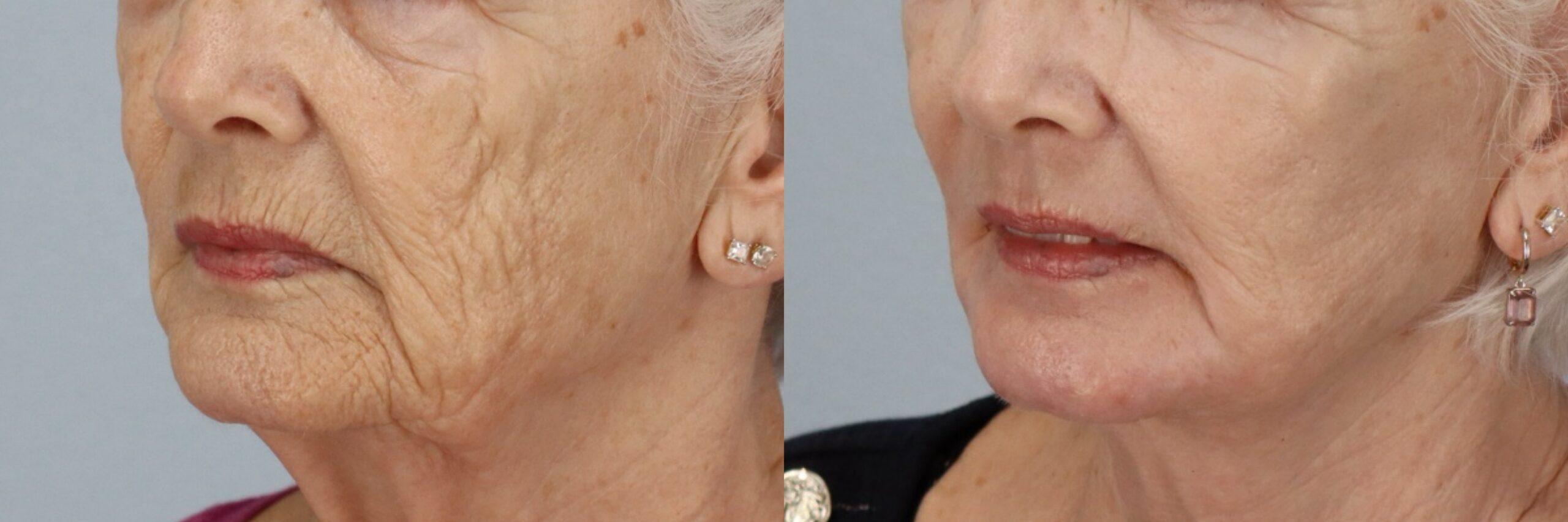 Before and after – Laser Resurfacing – Female patient, age 60+ – Image 8