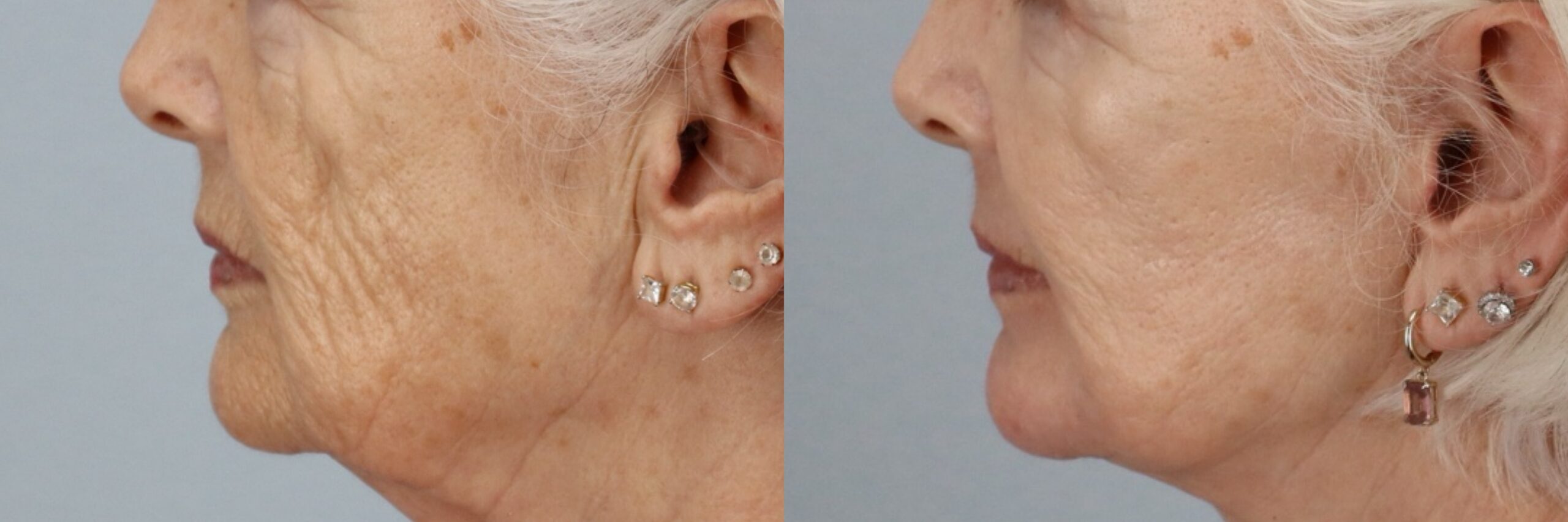 Before and after – Laser Resurfacing – Female patient, age 60+ – Image 9