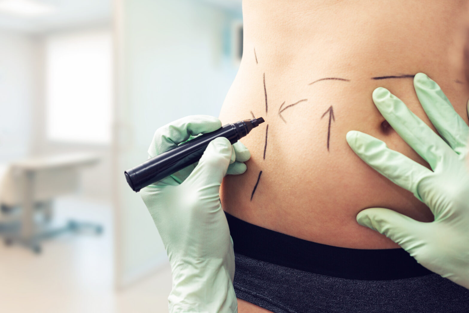 Tummy Tuck Surgery Markings