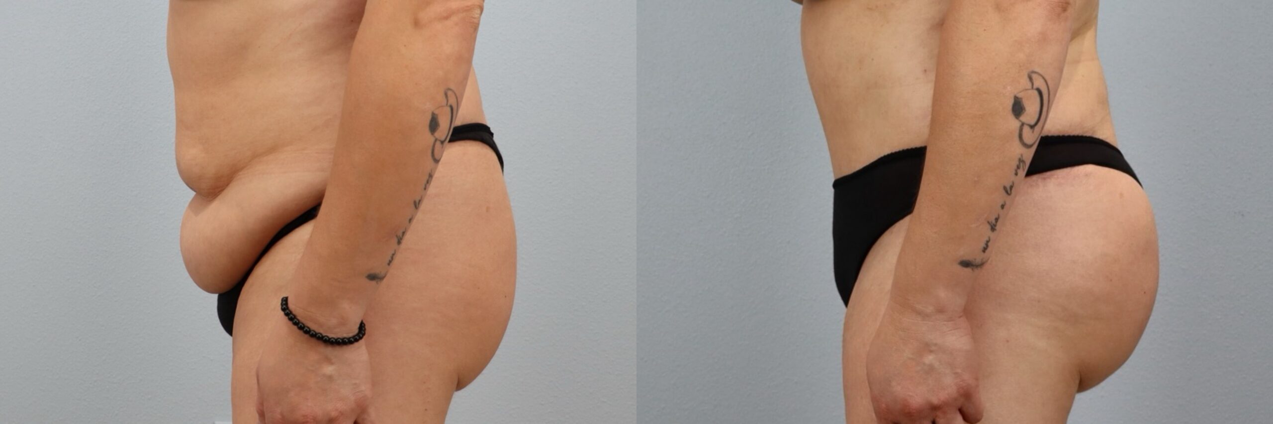 Before and after – Tummy Tuck – Female patient, age 40-49 – Image 33