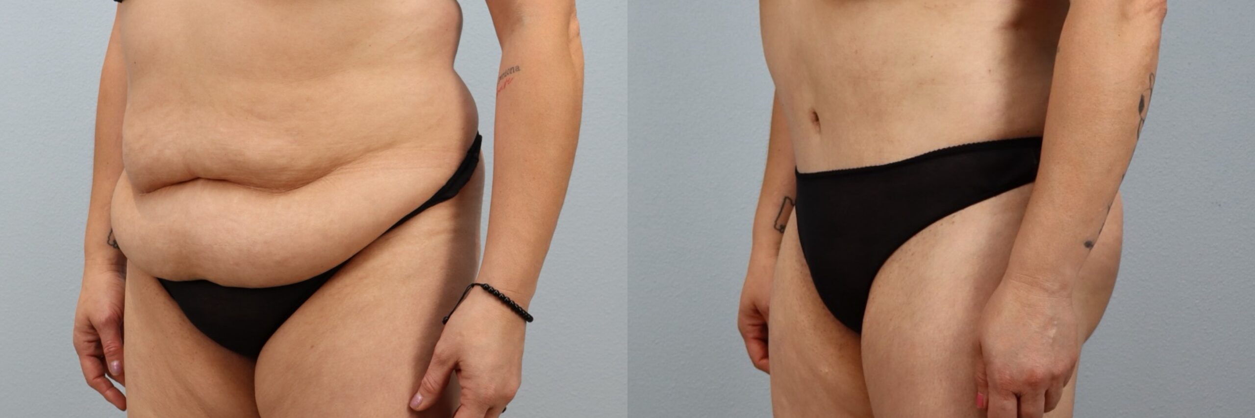 Before and after – Tummy Tuck – Female patient, age 40-49 – Image 32