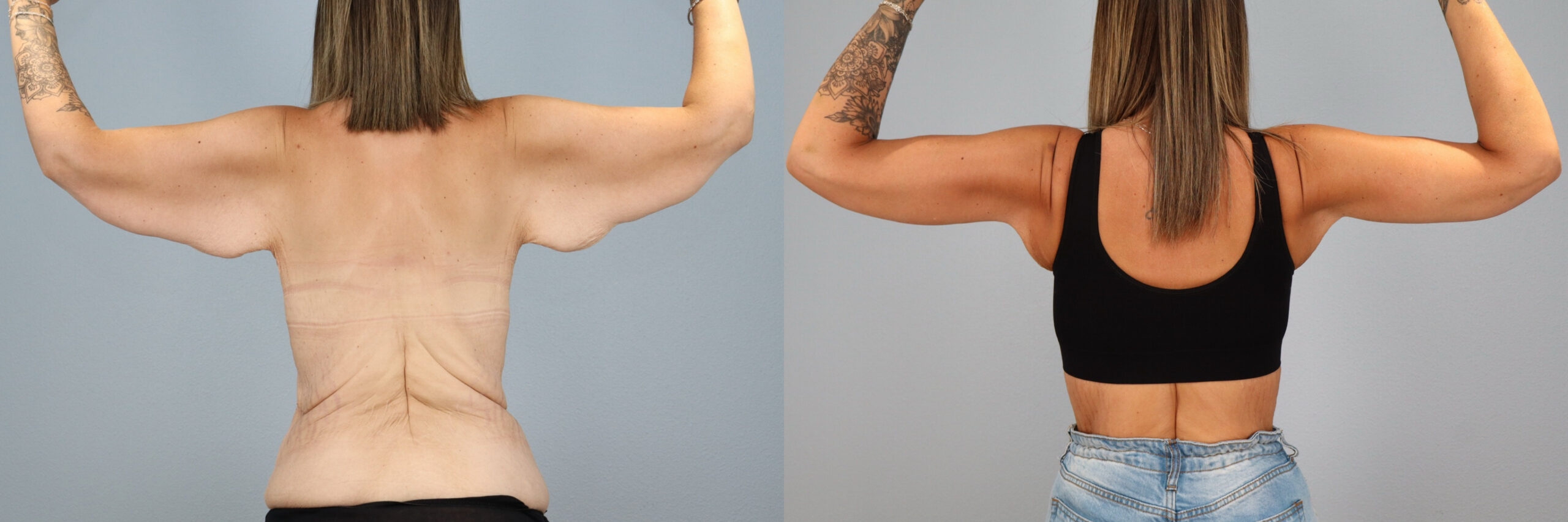 Before and after – Body Contouring – Female patient, age 30-39 – Image 26