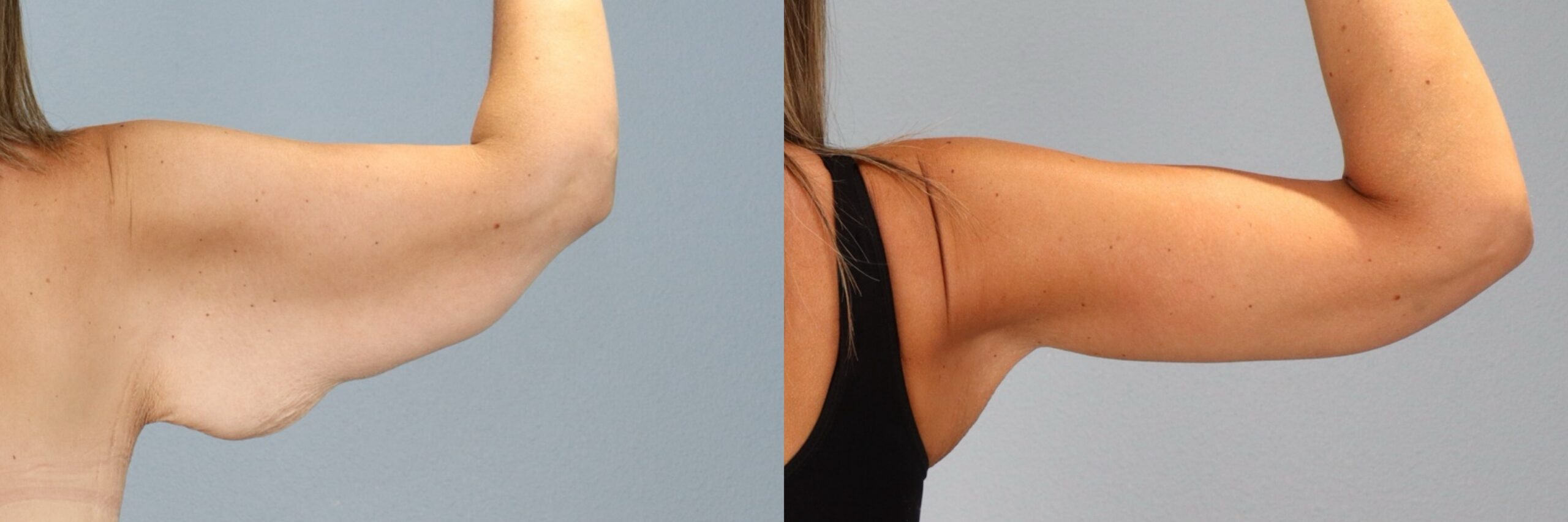 Before and after – Body Contouring – Female patient, age 30-39 – Image 27