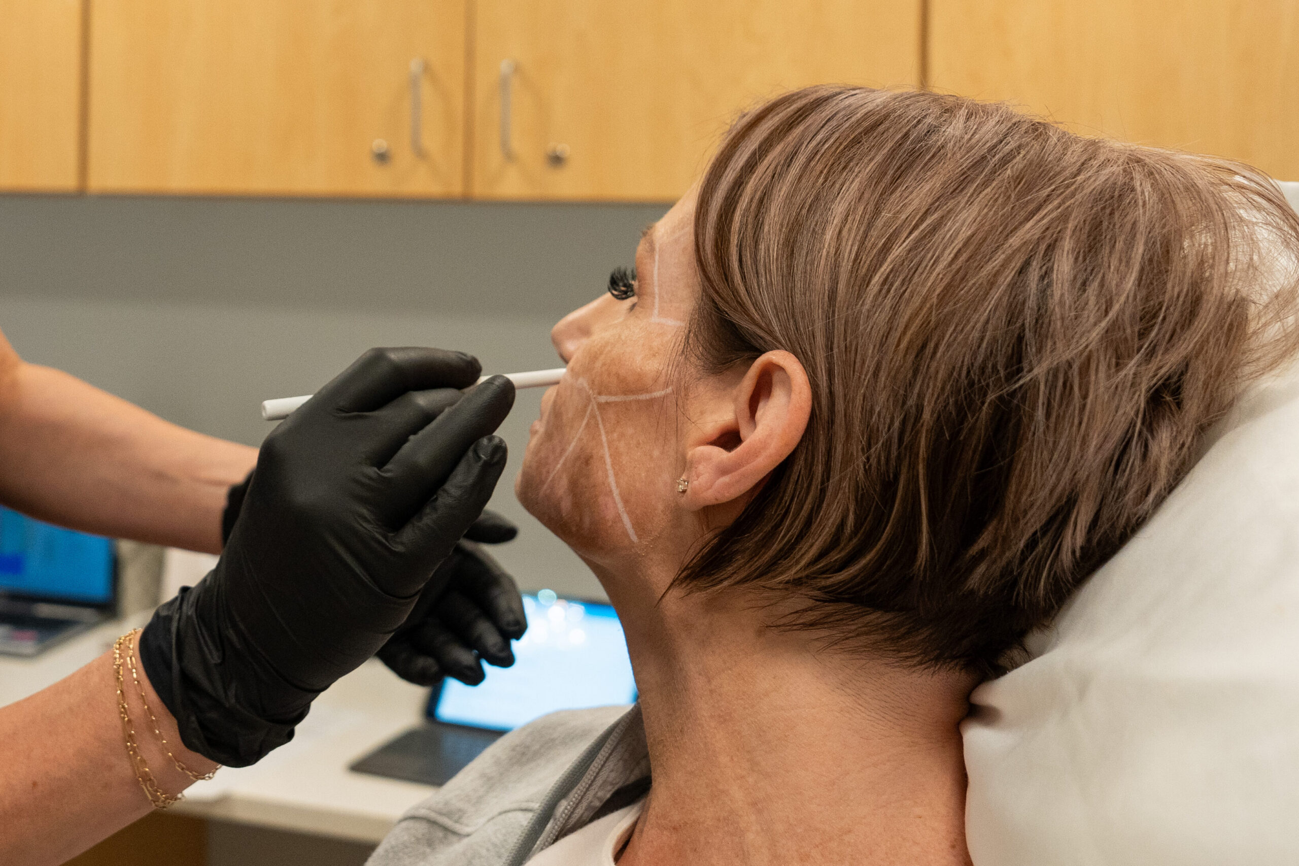 woman receiving dermal filler