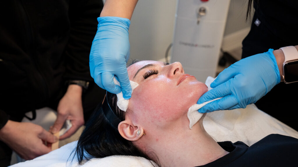 skin after CO2 laser treatment