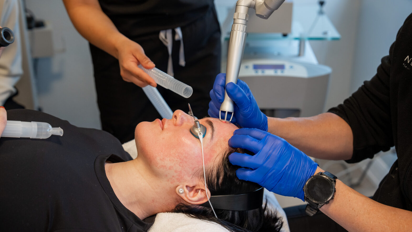 CO2 laser treatment