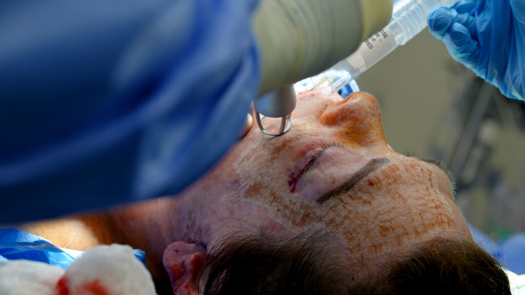 Deep CO2 laser treatment